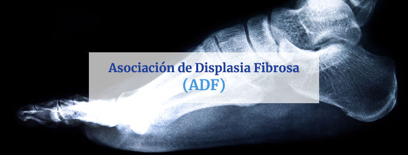 Asociación de Displasia Fibrosa y Síndrome de McCune-Albright