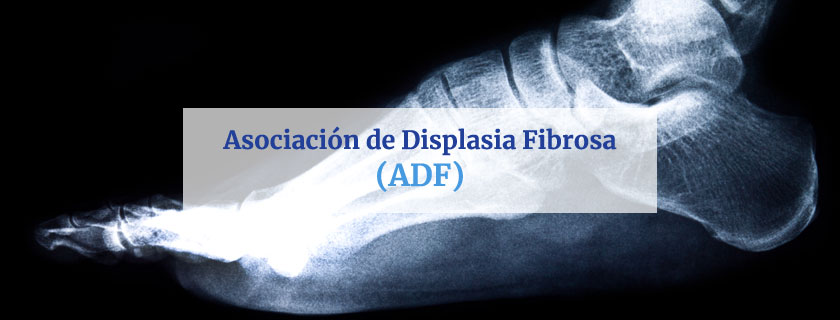 Asociación de Displasia Fibrosa y Síndrome de McCune-Albright